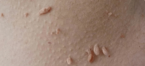 HPV transmission method