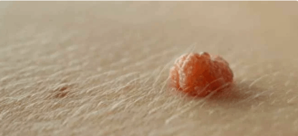 Papillomavirus