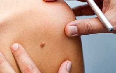 Methods of treating papillomas