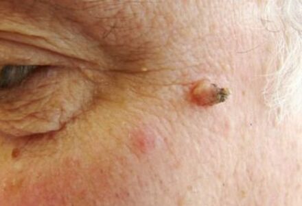 papilloma of the face