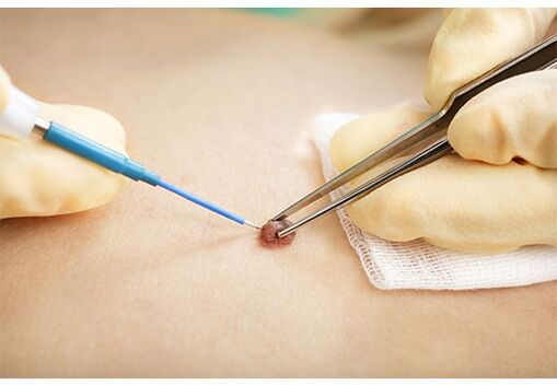 Removing papillomas