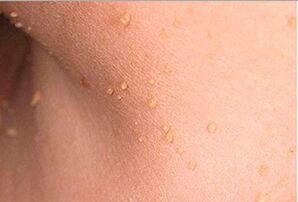 What do papillomas look like on the body