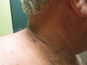 The reasons for the appearance of multiple papillomas on the body
