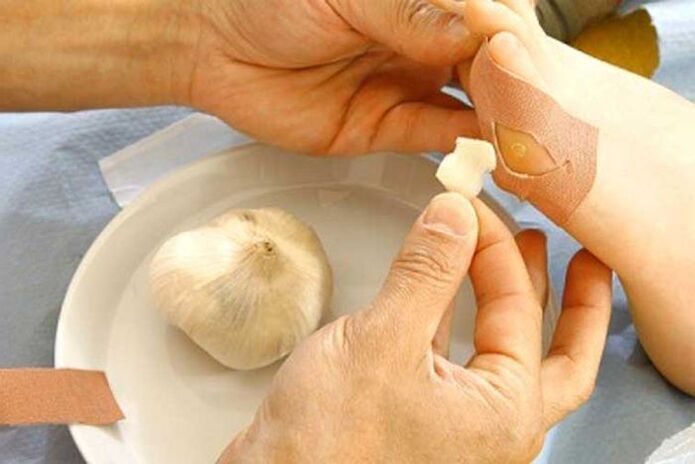 Treatment of papilloma with a compress with garlic