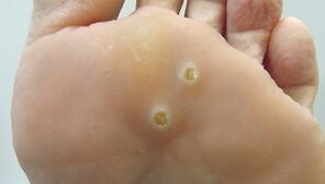 what does plantar wart look like