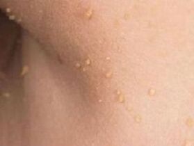 causes of the appearance of papillomas on the body