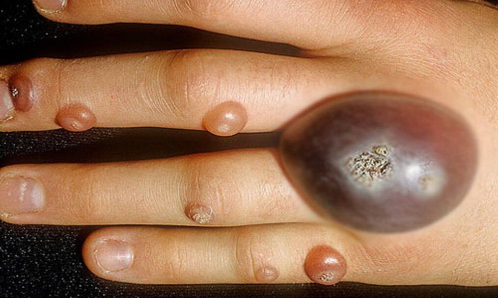 large warts on hands