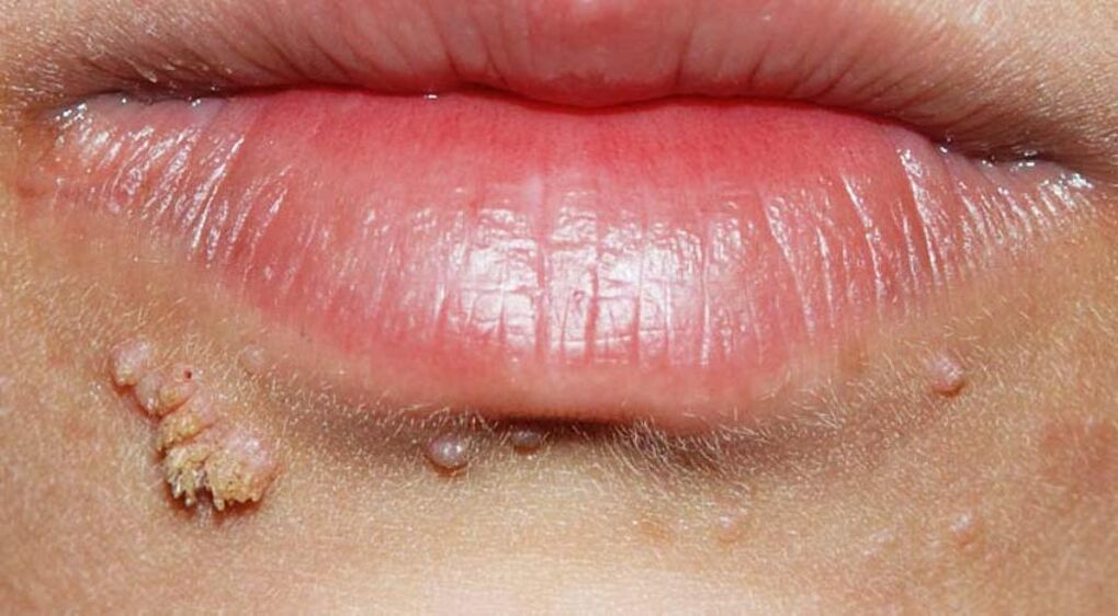 warts on the lips