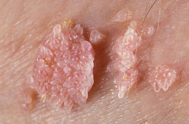 Papilloma is a benign tumor formation of the skin and mucous membranes with a warty character